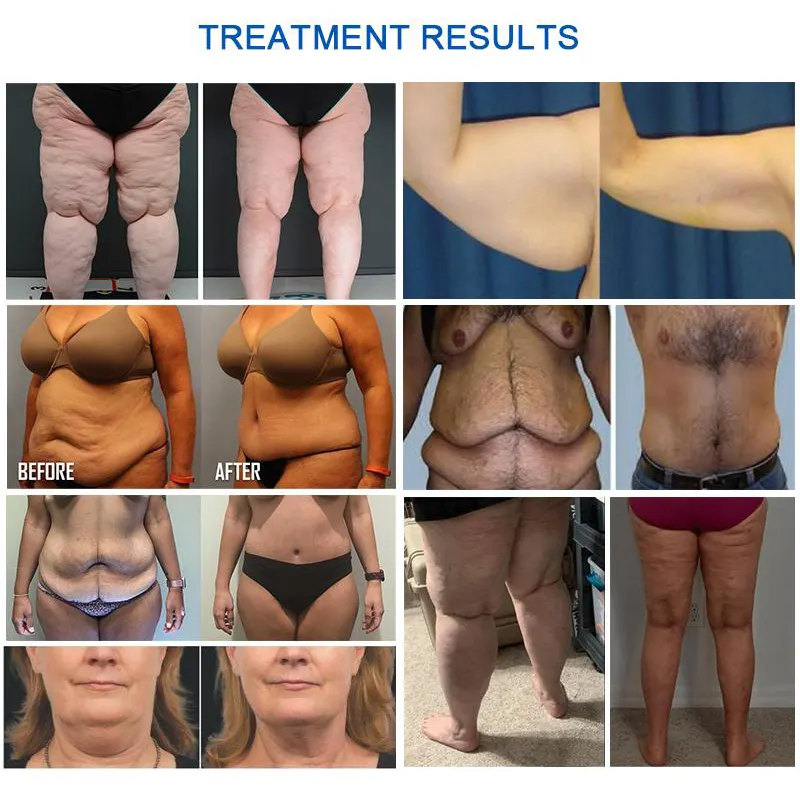 Cryo 360 Fat Freezing 40K Cavitation Therapy Cellulite Removal Slimming Machine