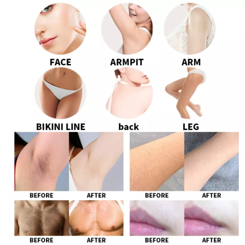 Painless 810nm Diode Laser Hair Removal Machine 810nm 755nm 1064nm Body Skin Rejuvenation