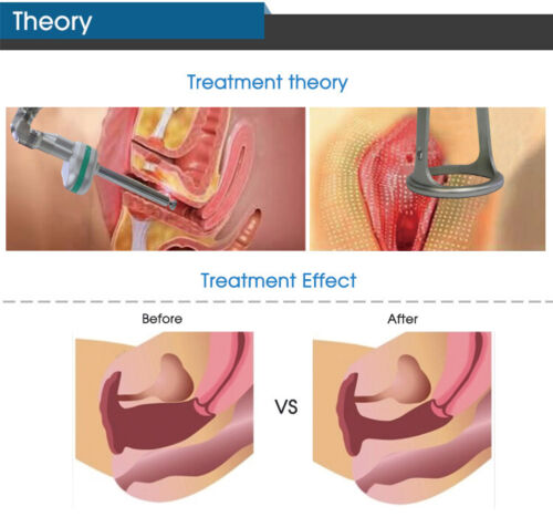 CO2 Fractional Laser Machine Skin Resurfacing Vaginal Tightening Device For Spa