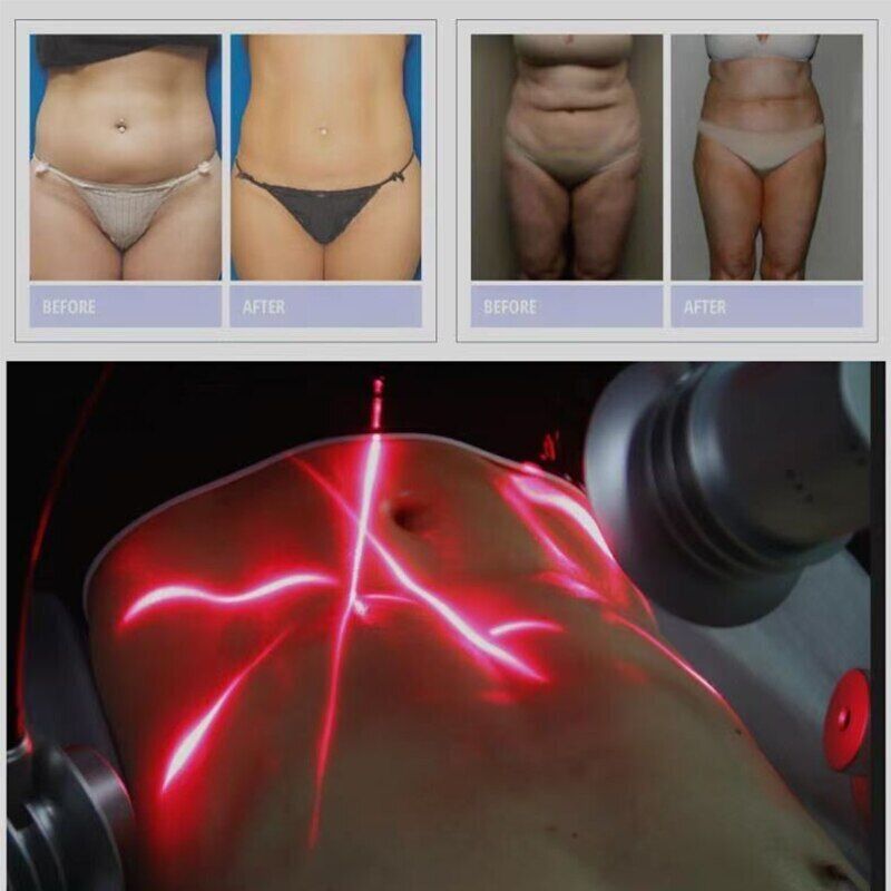 Professional 6D Laser Slimming Body Shape System 532nm Wavelengths Slim Machine
